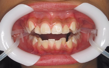 Isolate the teeth