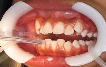 Dry teeth