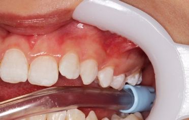 Dry teeth
