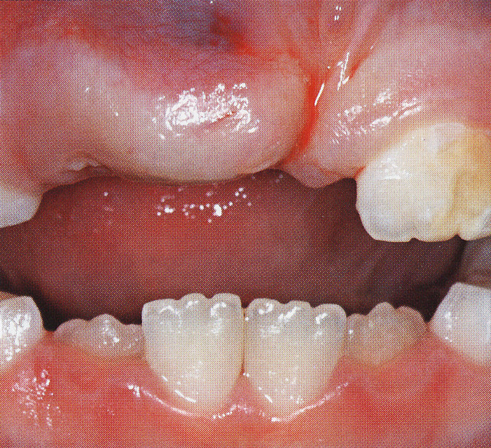 Tissue Trimmer - Clinical Case