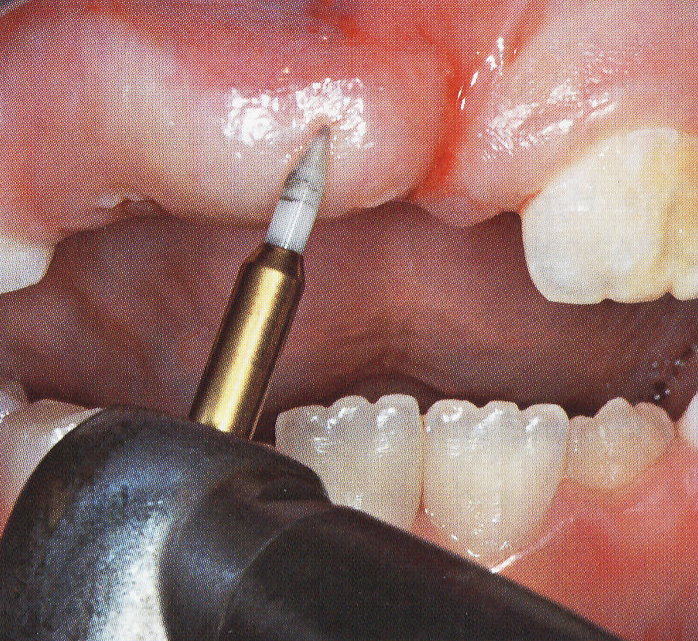 Tissue Trimmer - Clinical Case