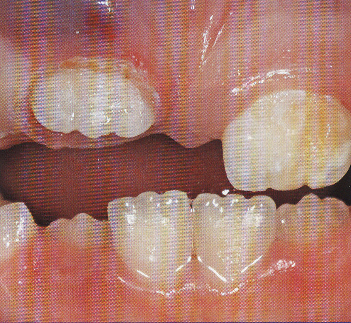 Tissue Trimmer - Clinical Case