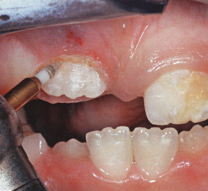 Tissue Trimmer - Clinical Case