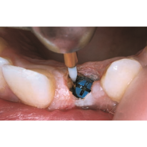 Tissue Trimmer - Opening of the implant