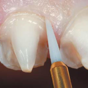 Tissue Trimmer - Opening the sulcus after crown preparation