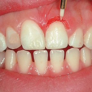 Tissue Trimmer - Contouring the gingiva and cutting the gingiva