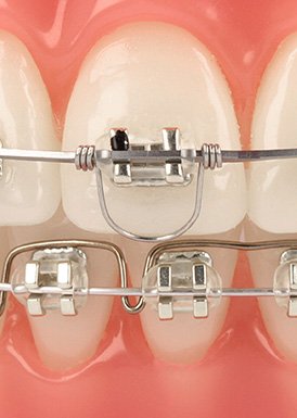 Warren Torquing Spring - Buccal (Negative) Root Torque